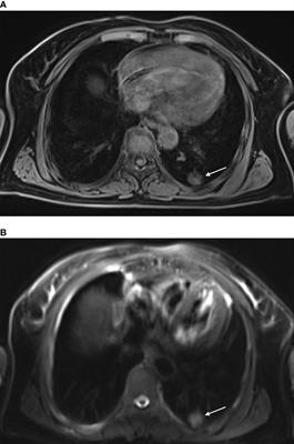 MR-Guided Microwave Ablation for Lung Malignant Tumor: A Single Center Prospective Study